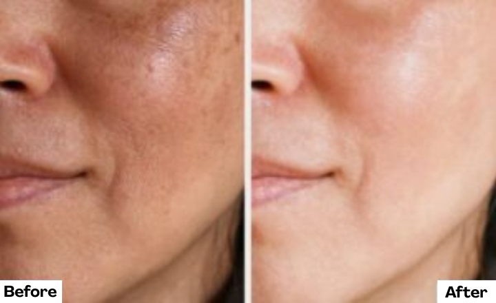 Before and After using Clogged pores skincare