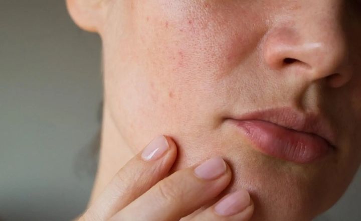 Is Whey Protein Cause Sebum Production?