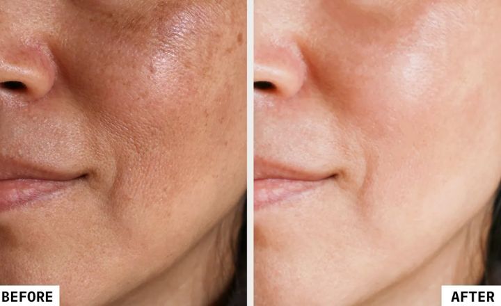 Before And After Clogged Pores