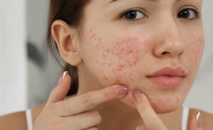 Best Moisturizers for Fungal acne