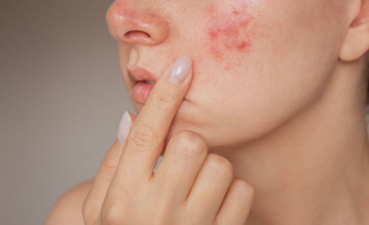 Salicylic Acid Adverse Effects