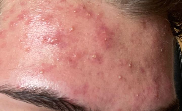Side Effect Of Medik8 Crystal Retinal