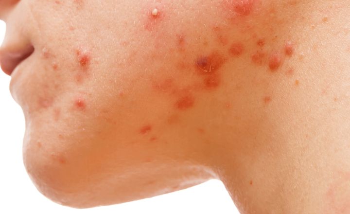 Skin Purging