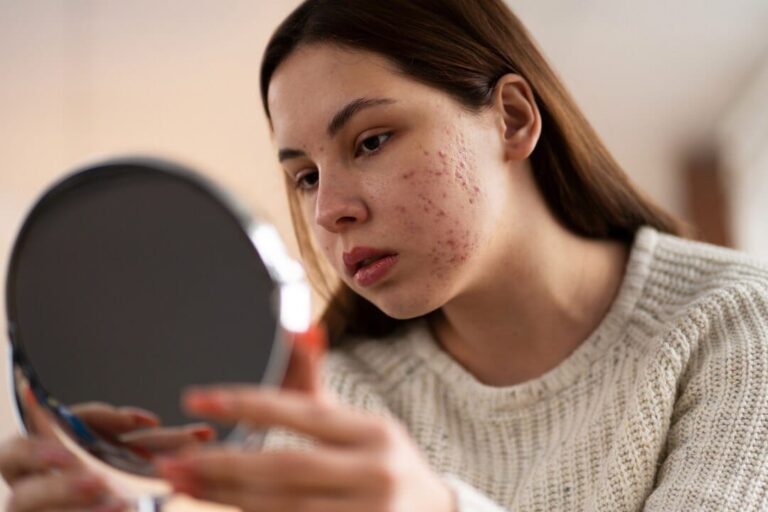 Is Acne Purging Really Triggered By CeraVe SA Cleanser