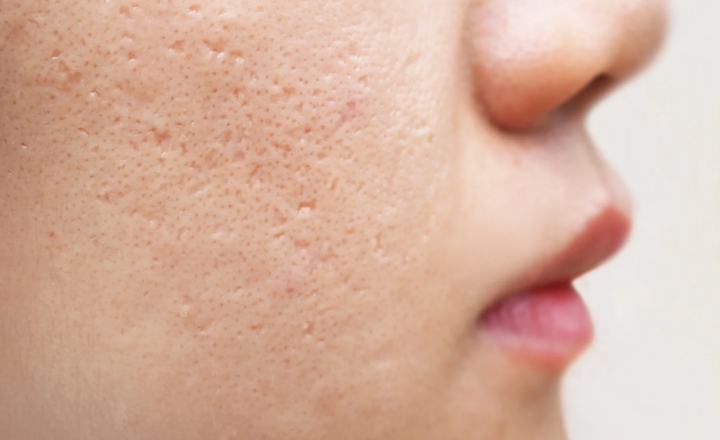 How to Get Rid of Acne Scars? acne scar treatment options