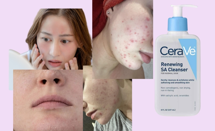 Does Cerave SA Cleanser Cause Purging