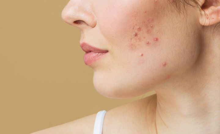Comedones on cheek