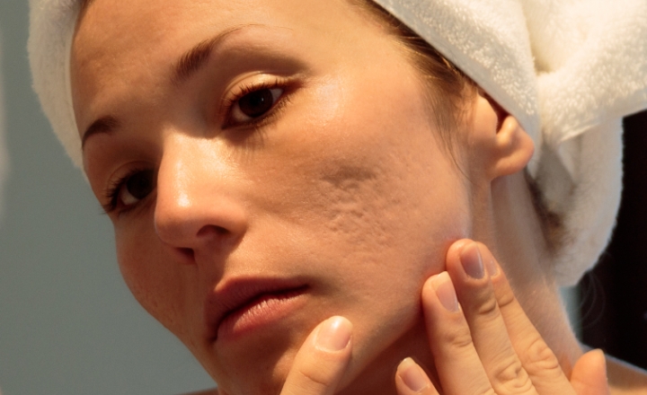 Korean Skincare for Acne scars - Exfoliants