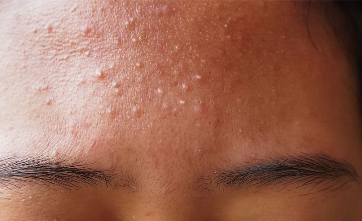 Fungal acne on forehead
