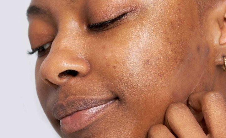 Korean Skincare For Acne Scars