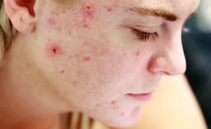 Best Oil Cleansers For Acne Prone Skin