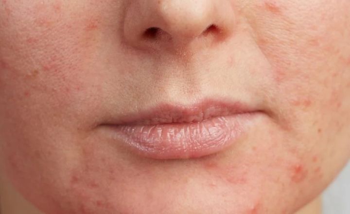 side effects of retinol