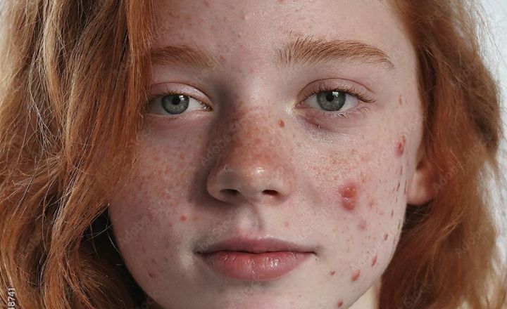 Gentle Skincare for Teen Acne