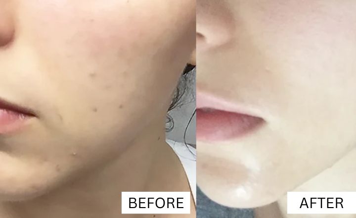How to Get Rid of Acne Scars? Before vs After