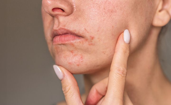 Best Sunscreen for Perioral Dermatitis