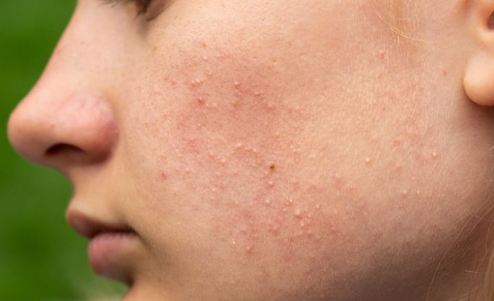 What is the Best SPF for Closed Comedones?