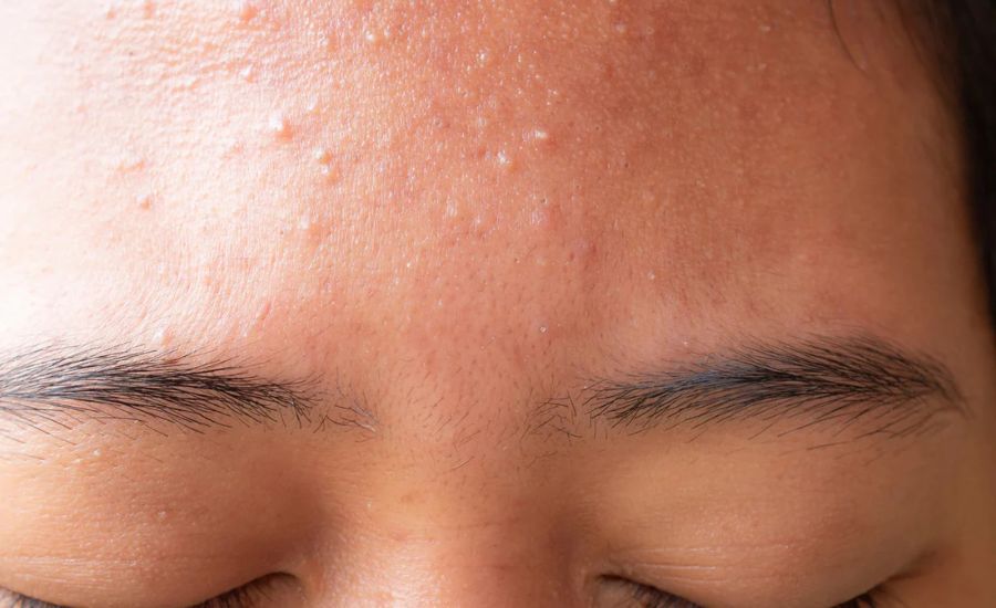 Best Mineral Sunscreen for Sensitive Acne Skin