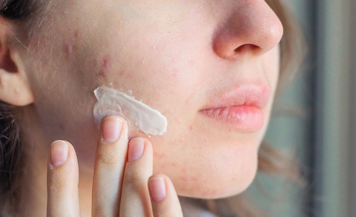 Benefits of Salicylic Acid to Acne Prone Skin