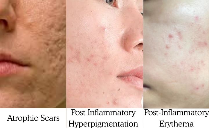 Three Major Types of Acne Scars