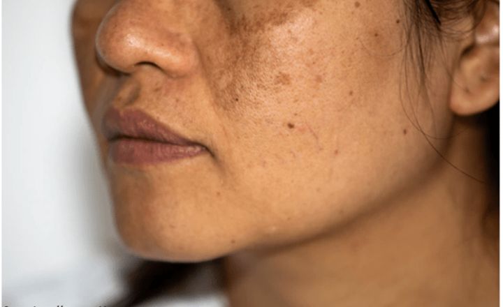 post-inflammatory hyperpigmentation