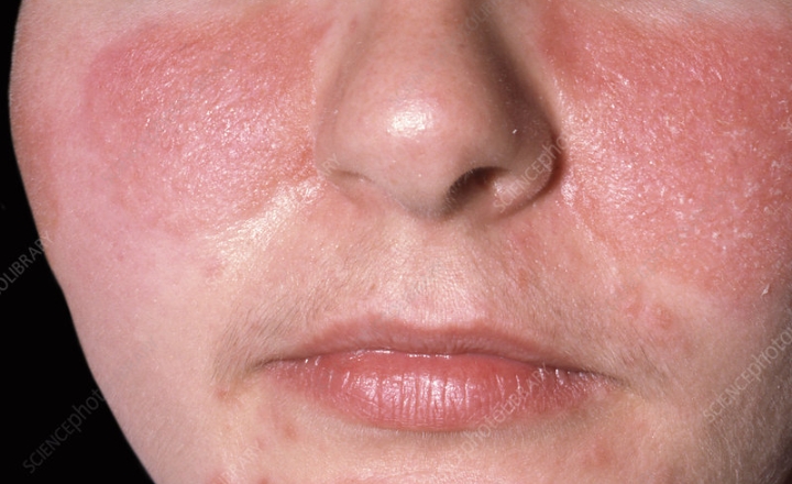 Facial Seborrheic Dermatitis