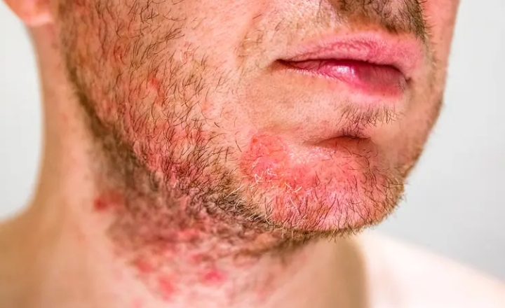 Best Face Washes for Seborrheic Dermatitis Treatment