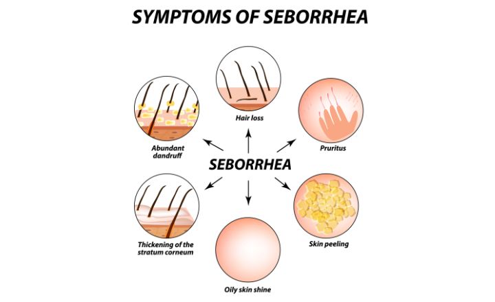 Symptoms of Seborrheic Dermatitis