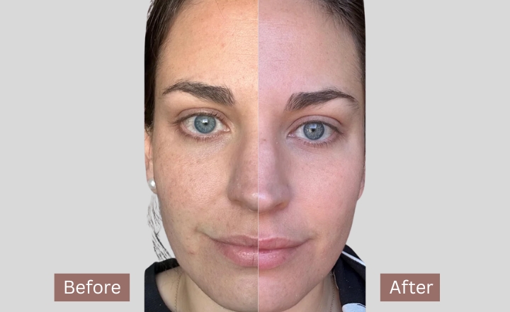 Benefits of Tretinoin