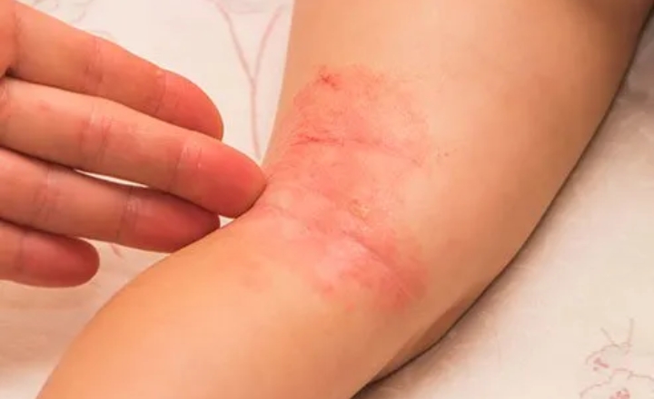 Best Soap for Intertrigo Skin Rash - Causes & Treatment