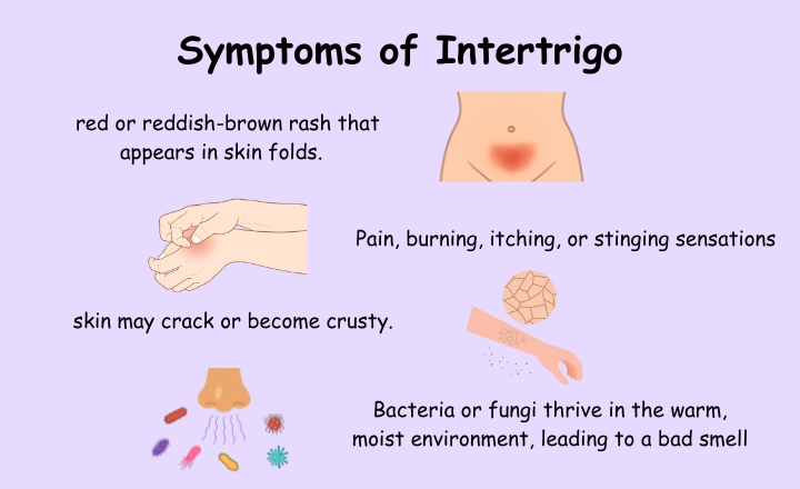 Symptoms of Intertrigo