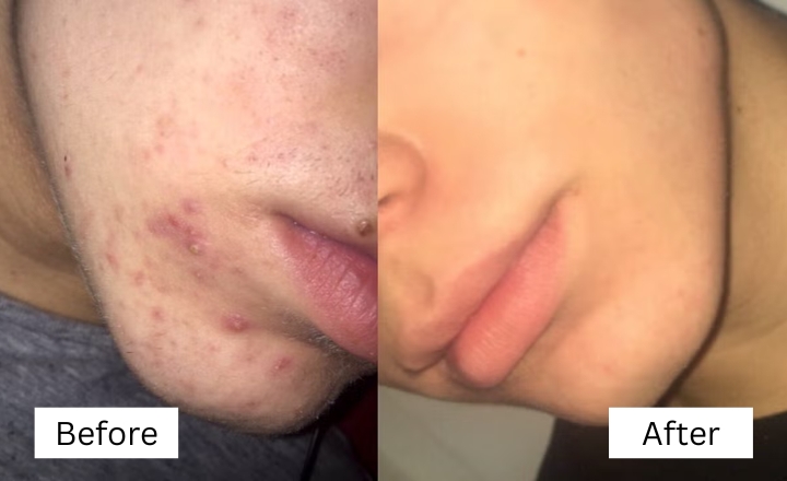 Tretinoin Freckles Before After - What to Expect