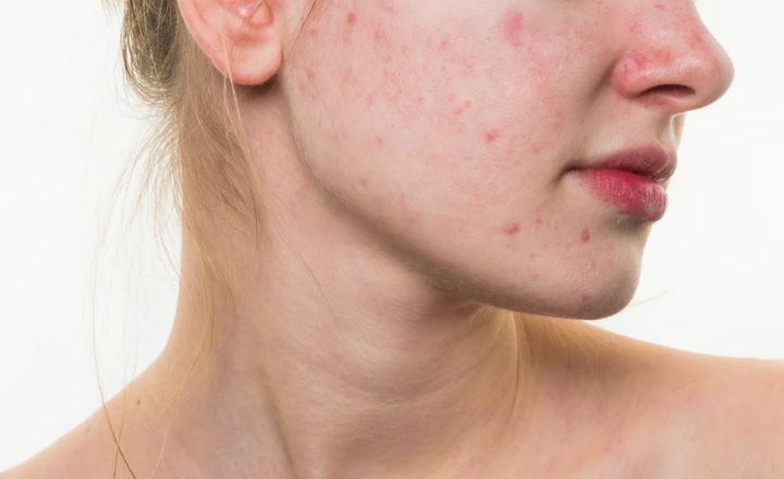 lactic acid for skin